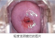 轻度宫颈糜烂图片
