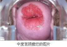 中度宫颈糜烂图片