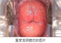 重度宫颈糜烂图片