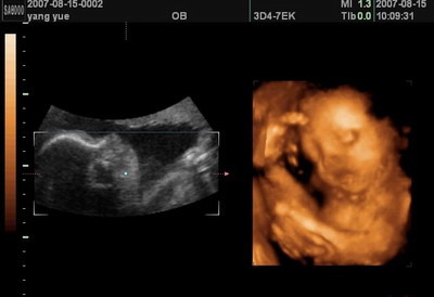 26周胎儿四维彩超图