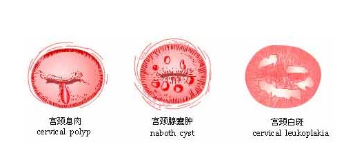 宫颈白斑图片