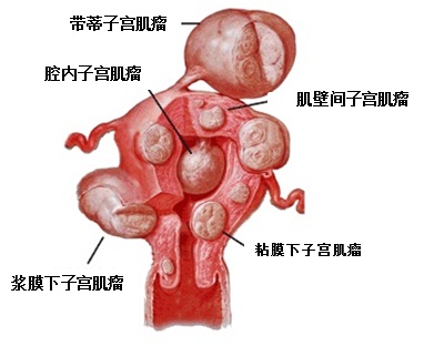 子宫肌瘤图片