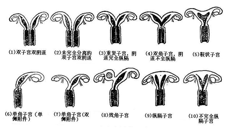 子宫发育异常图片