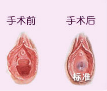 处女膜修复图