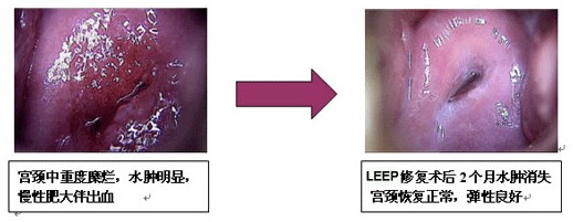 宫颈糜烂治疗效果对比图