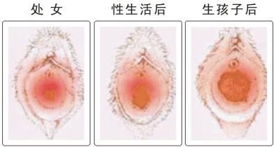 处女膜修复手术多少钱？有哪些注意事项