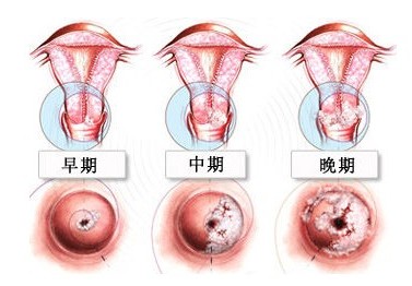 宫颈糜烂怎么治疗