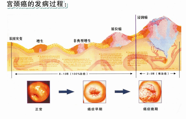 宫颈癌筛查的年龄