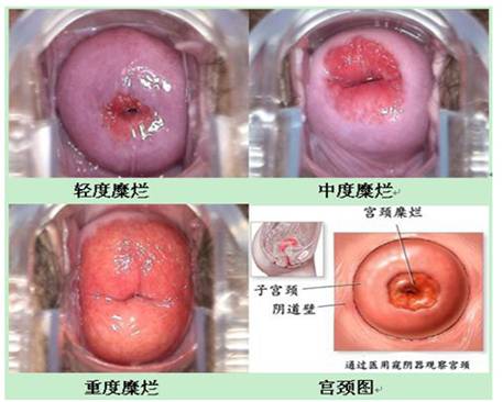 宫颈糜烂的治疗