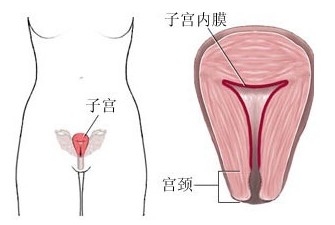 子宫腔粘连