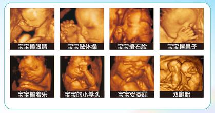 孕妇做四维彩超【咨询】作用在哪