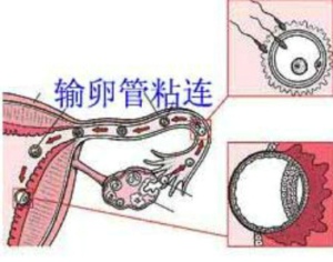 输卵管不通怎么办